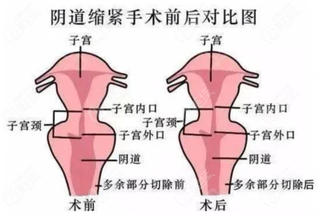 做私密緊致手術(shù)