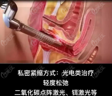 做私密緊致手術(shù)