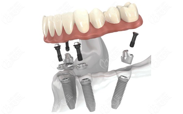 鹽城鼎植口腔微創(chuàng)種植“快又準(zhǔn)”