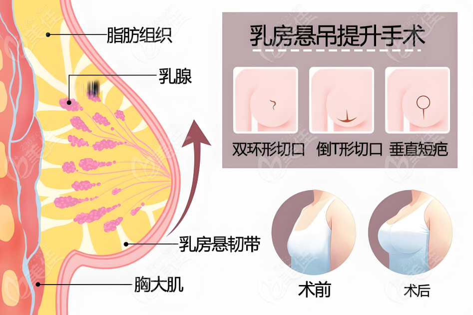乳房下垂悬吊手术