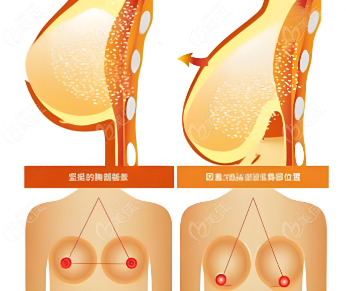 如何联系段国新医生乳房下垂悬吊提升手术