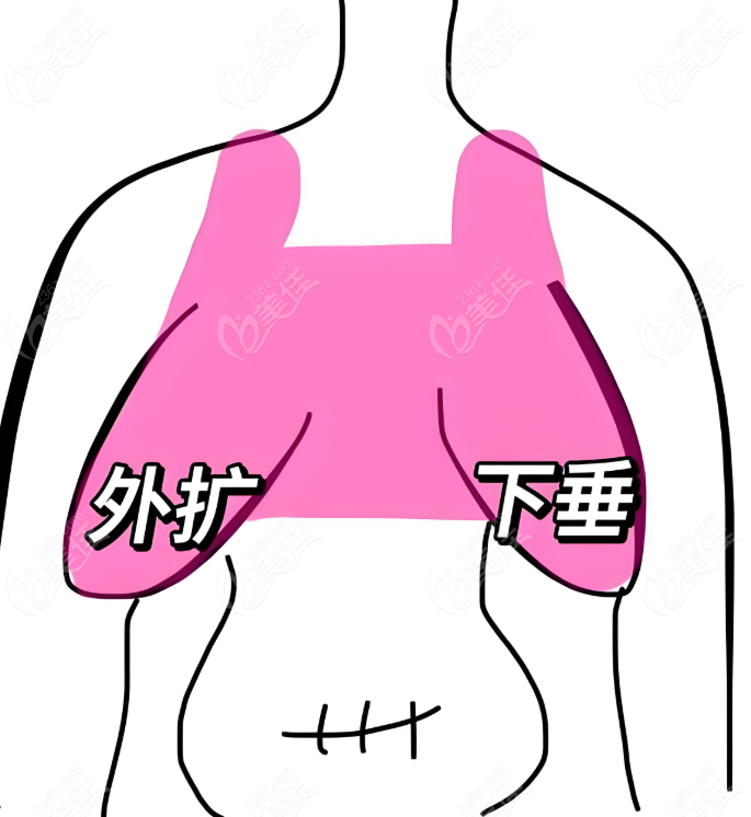 胸部下垂