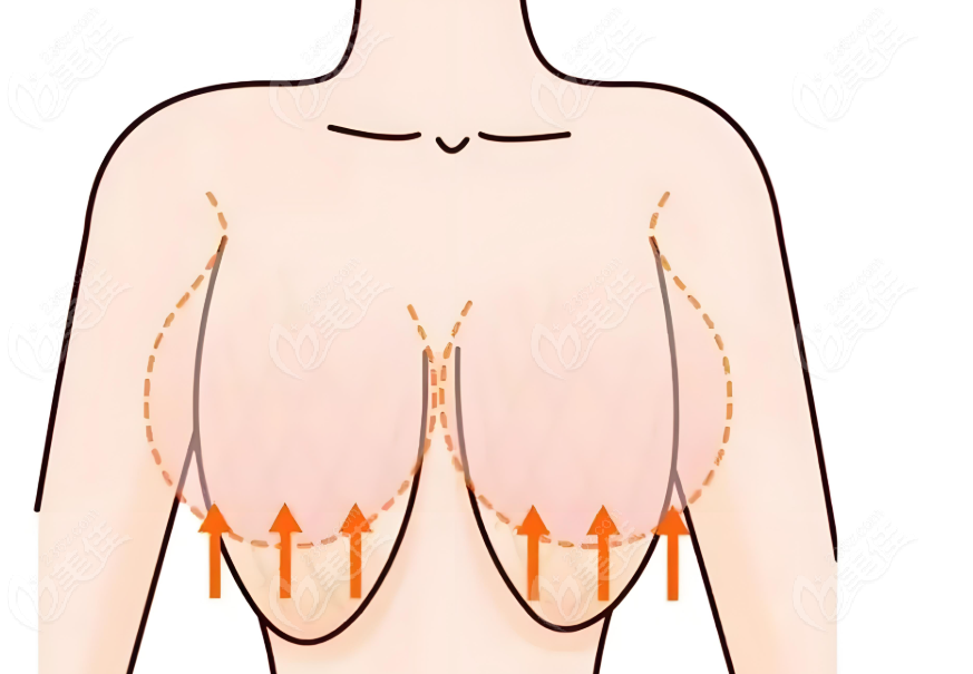 段国新医生乳房下垂悬吊提升手术技术总结+预约指南www.236z.com
