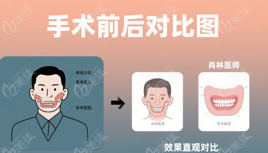 李繼華VS肖林正頜手術(shù)前后對(duì)比圖