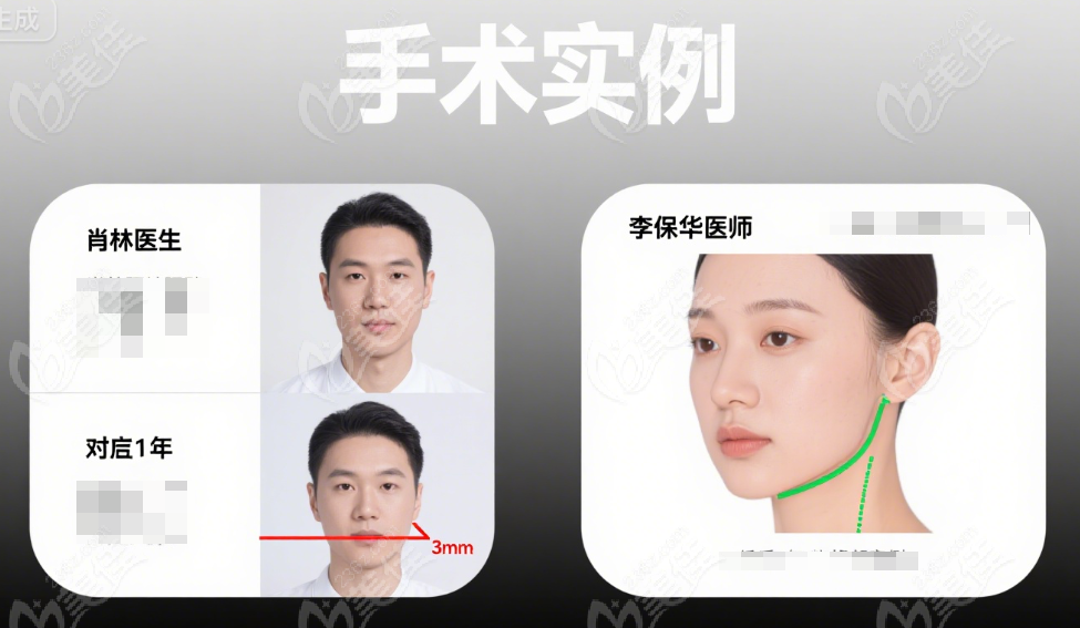 肖林vs李继华做颧骨内推手术实例对比