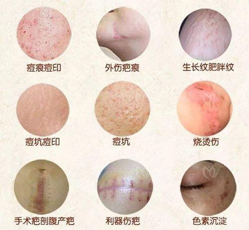 刘志超疤痕修复技术特色