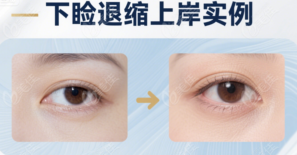 談?dòng)铗v修復(fù)下瞼外翻真人實(shí)例