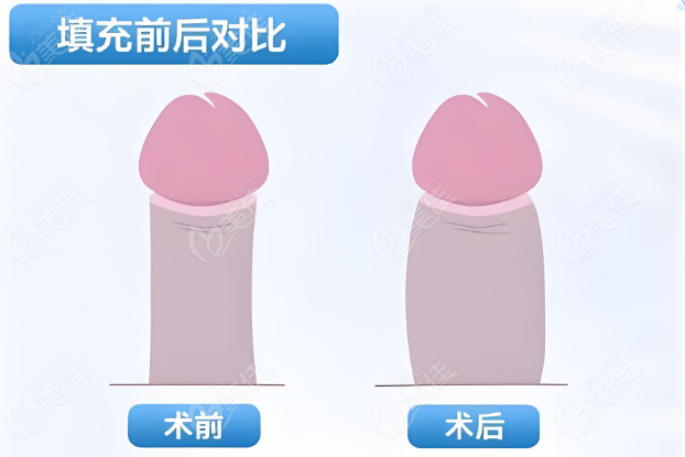 上海程开祥做阴茎增粗延长便宜又好