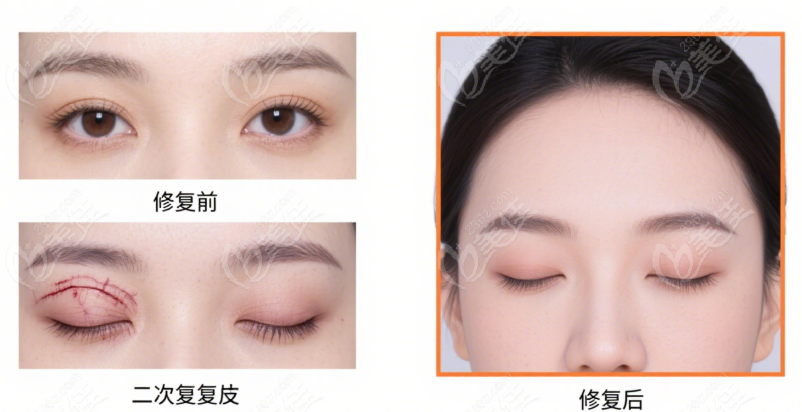 双眼皮修复前后对比