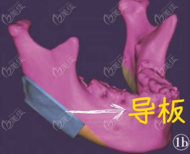 刘正茂磨骨是用导板吗