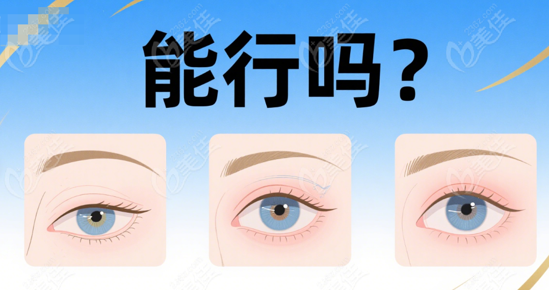 上海楊超醫(yī)生高難度眼修復(fù)