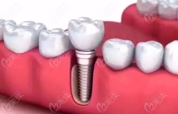 口腔种植