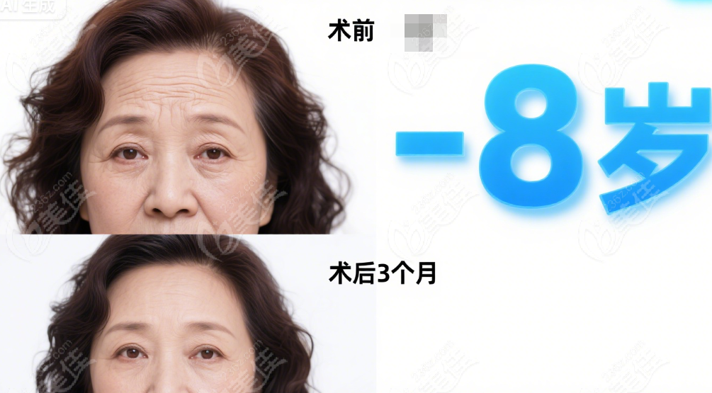 谢宏彬内窥镜额头提升真实实例
