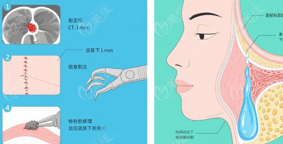 张立彬跟王绍国哪个腻害？术后管理与复发控制大对决