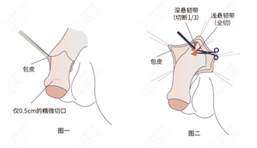 李世荣阴茎延长术手术过程详解
