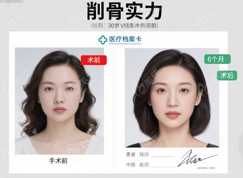 李志海磨骨削骨成功实例