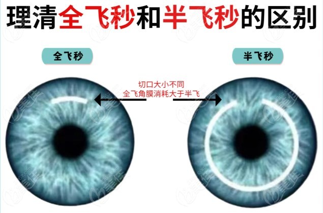 飞秒近视眼手术