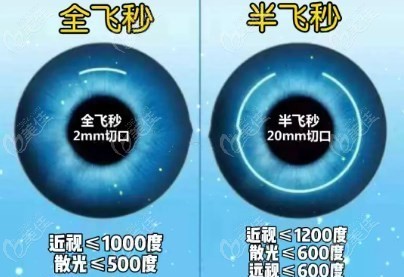 近视眼手术