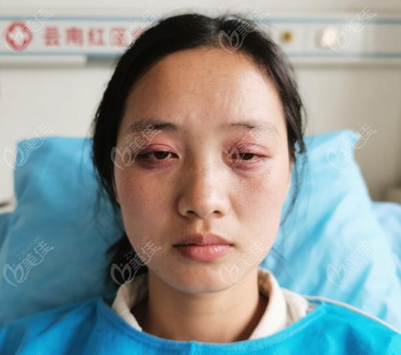 在昆明紅會(huì)醫(yī)院做完上眼瞼下垂手術(shù)的我后悔了