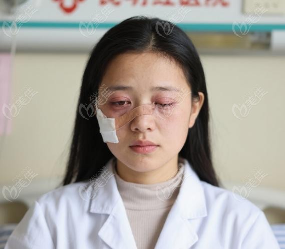 在昆明紅會(huì)醫(yī)院做完上眼瞼下垂手術(shù)的我后悔了：評(píng)估打消顧慮