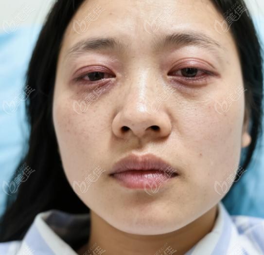 在昆明紅會(huì)醫(yī)院做完上眼瞼下垂手術(shù)的我后悔了：手術(shù)日體驗(yàn)實(shí)錄
