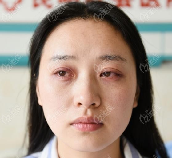 在昆明紅會(huì)醫(yī)院做完上眼瞼下垂手術(shù)的我后悔了：期驚喜連連