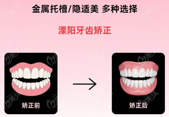溧阳牙齿矫正价格