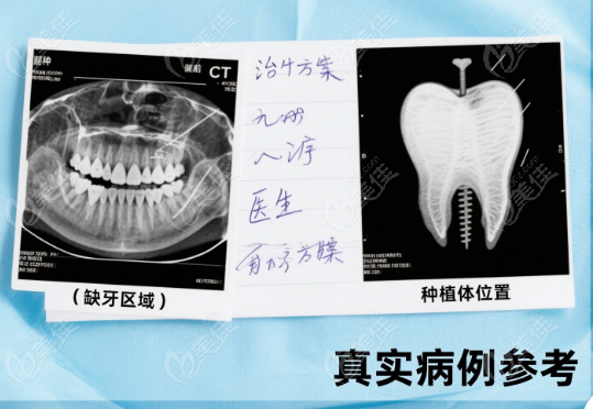溧阳种植牙低价榜单