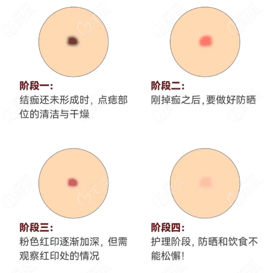 点痣四阶段早看不受罪