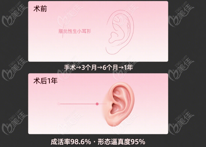 吴建明全耳再造成功病例