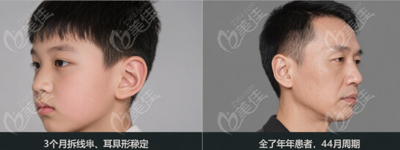 郭树忠做的耳朵形态自然稳定
