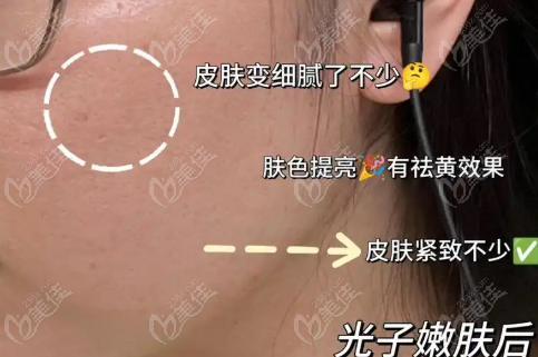 光子嫩肤