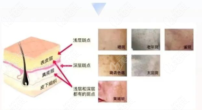 光子嫩肤