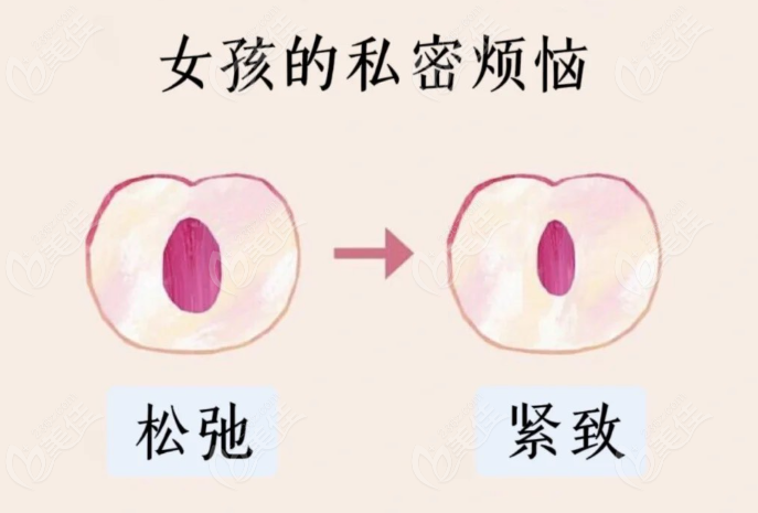 上海虹桥医院私密修复手术靠谱