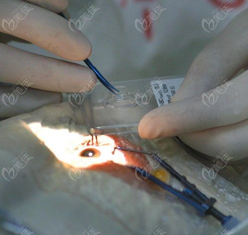 昆明紅會眼科醫(yī)院白內(nèi)障門診當(dāng)天流程 昆明紅會眼科醫(yī)院白內(nèi)障門診當(dāng)天流程