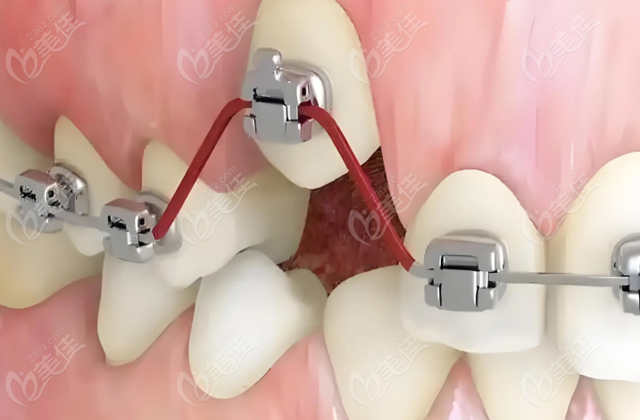 换个钢丝的牙套选择建议www.236z.com