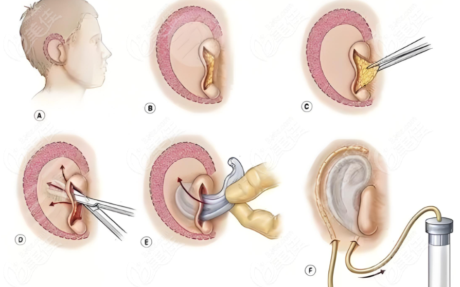 如何缩短八大处耳再造总周期www.236z.com
