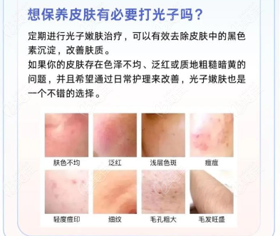 做光子嫩肤