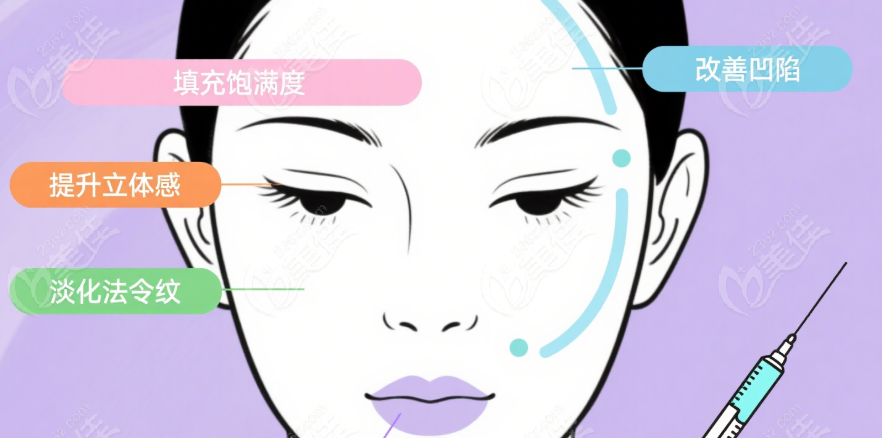 乔雅登盈致玻尿酸注射