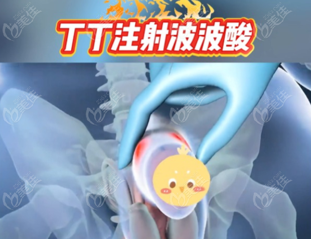 重庆星荣整形做龟头玻尿酸增大手术费用大概2.8万起