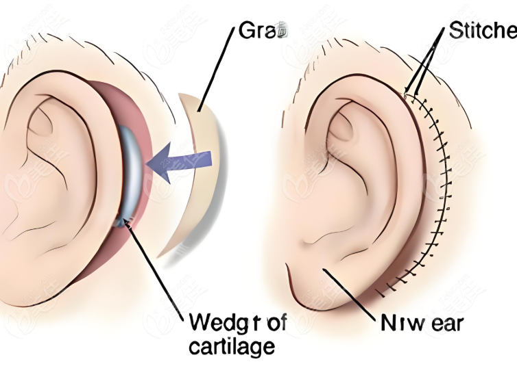 耳再造 耳再造