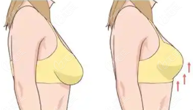 重慶整形醫(yī)生劉巍縮胸手術技術怎么樣