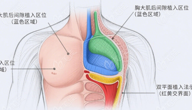 西安玻尿酸丰胸医院排名