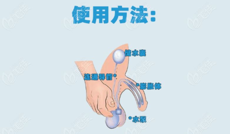 成都阴茎假体三件套费用