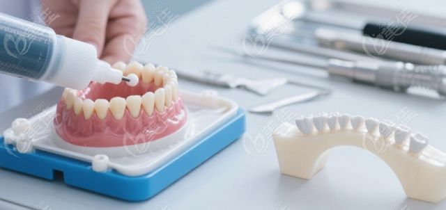 钦州康美口腔做马里兰桥