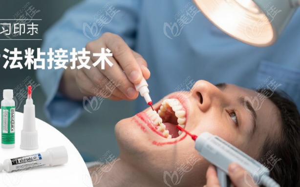 钦州美澳口腔做马里兰桥牙修复