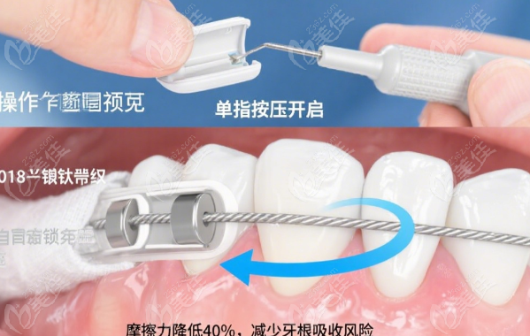 普特自锁托槽是主动托槽吗