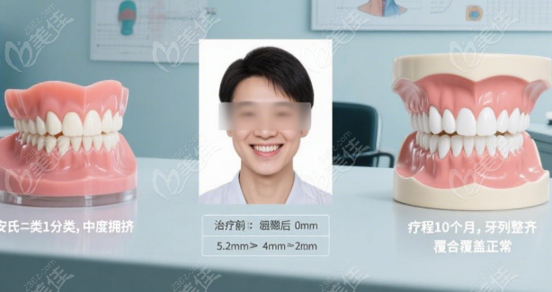 普特自锁托槽防伪指南