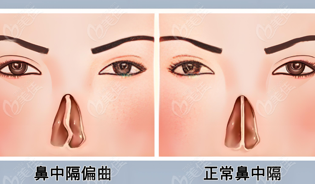 鼻中隔偏曲手术www.236z.com