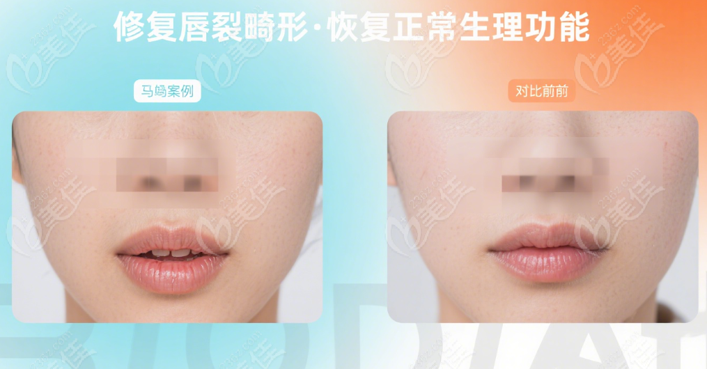 马群和潘柏林真实唇腭裂病例